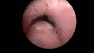 UroLift® System Office Procedure Dr Gange amp Dr Richardson [upl. by Gordon]