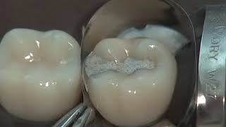 Class II Amalgam Preparation amp Restoration  Operative Dentistry [upl. by Everara]