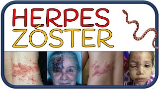 HERPES ZÓSTER  culebrilla síntomas herpes zóster oftálmico Sx RamseyHunt y complicaciones [upl. by Ruvolo667]