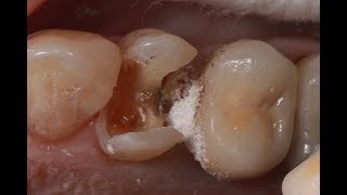 How to use caries dye indicator on badly destructed teeth [upl. by Akcinat]