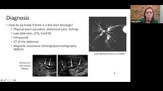 Webinar Biliary stent and drain management for patients with cholangiocarcinoma [upl. by Timi]