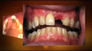 Front Dental Implant  1 hour Same Day [upl. by Dola]