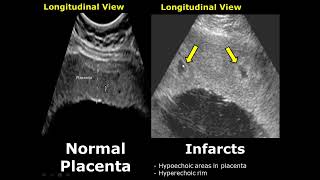 Placenta Ultrasound Normal Vs Abnormal Image Appearances Comparison  Placental Pathologies on USG [upl. by Yoshi]