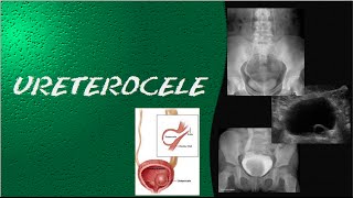 Videoaula e dicas em RADIOLOGIA  ultrassonografia urografia excretora e cistografia  Ureterocele [upl. by Moffitt]