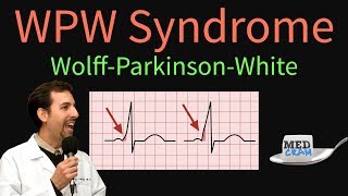 WPW  WolffParkinsonWhite Syndrome ECG  EKG findings symptoms pathology amp treatment [upl. by Nowyt]