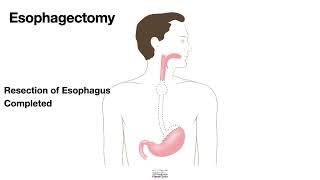 HCC 147510a  Surgical Anatomy  Esophagectomy [upl. by Aikaj]