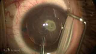 Pediatric posterior lenticonus cataract posterior capsulorhexis with optic capture toric IOL [upl. by Hannavahs679]