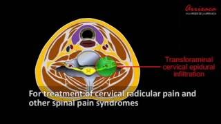 CERVICAL EPIDURAL TRANSFORAMINAL INFILTRATION Cervical radicalar block [upl. by Elocaj]