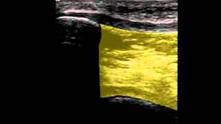 Musculoskeletal Ultrasound Knee 3 infrapatellar longitudinal scan [upl. by Humfried]