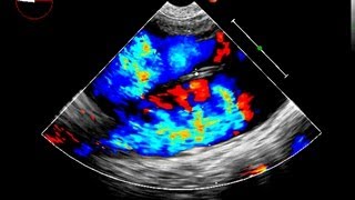 Aortic Dissection Echocardiography [upl. by Regdor]