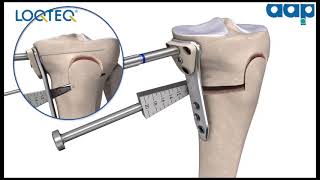 LOQTEQ® High Tibia Osteotomy 45  Surgical Technique [upl. by Adnilam288]