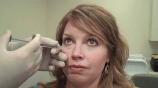 Juvéderm™ Tear Trough Treatment Huntsville Alabama  Dr David L Durst [upl. by Arotal]