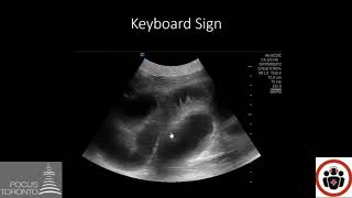 POCUS Cases 5 Small Bowel Obstruction [upl. by Aven]