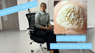 Verruca Wart Removal Laser Treatment [upl. by Eibrik]