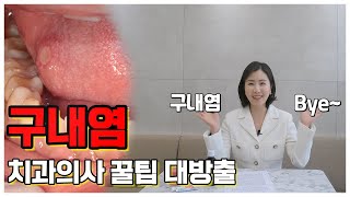 하루 종일 신경 쓰이는 구내염 원인과 빨리 낫는 법feat알보칠 안 아프게 바르는 꿀팁 [upl. by Zilvia]