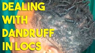 Dandruff amp Starter Locs [upl. by Brander]