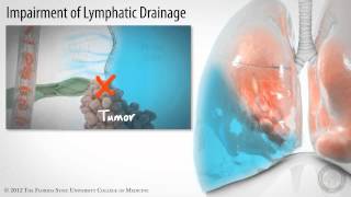 Pleural Space Part 3 of 3 Pleural Effusions HD [upl. by Thurston]