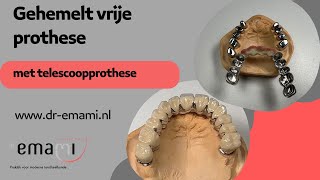 Gehemelte vrije prothese telescoopprothese kunstgebit zonder gehemelte [upl. by Nnaegroeg104]