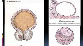 Hypertrophie bénigne de la prostate Dr Kerroumi S [upl. by Radferd]