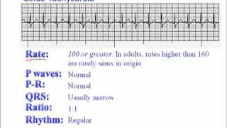 ECG Sinus Tachycardia [upl. by Asiled677]