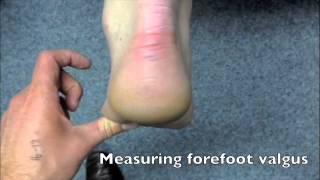 Forefoot Valgus [upl. by Alyt]