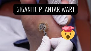 GIGANTIC Wart Removal Verruca Needling [upl. by Gregrory120]