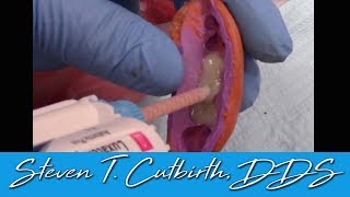 Temporary Crowns Quick and Easy Fabrication  Dental Minute with Steven T Cutbirth DDS [upl. by Grange342]