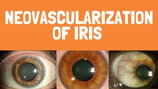 Causes of Neovascularization of iris  Rubeosis iridis  Ocular signs [upl. by Tilagram519]