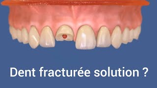 Dent fracturée solution  réparation dent cassée devant par la résine composite [upl. by Neirda]