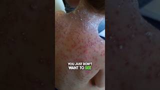 Chicken Pox What It Looks Like and How to Treat It [upl. by Airretal934]