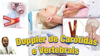 Ultrassonografia Doppler de Carótidas e Vertebrais  Exame e Diagnósticos [upl. by Slaughter]