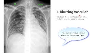 Bagaimana gambaran radiologi oedem pulmo [upl. by Nauh]