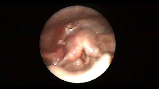 Endoscopic Assessment of Pharynx and Larynx After Blunt Injury To The Neck [upl. by Cynara446]