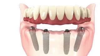 Allon4 Dental Implants Simple Procedure Animation [upl. by Aicsile]