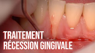 Traitement d’une récession gingivale profonde en 41 [upl. by Warms]