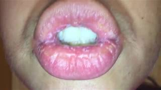 Exfoliative Cheilitis  August 8 2017  Day 2 of Nothing on my Lips [upl. by Gnouhk]