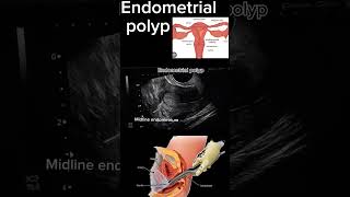 Endometrial Polyp Case Study A StepbyStep Diagnosis health ultrasound polyp DrSaimakhan [upl. by Joane]