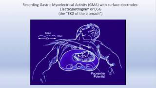 Gastroparesis Review and Update by Kenneth Koch MD [upl. by Samy503]