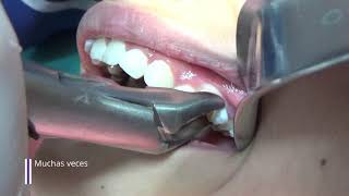 Extracción dental en niñosExtracción de dientes temporales [upl. by Pincince]