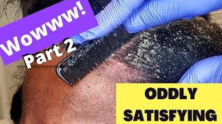 Oddly Satisfying Insane Dandruff Scratching Flakes Scalp Condition Removal After Braids Pt 2 [upl. by Ludie377]