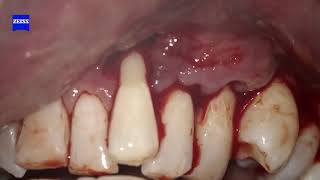 Microsurgery for lateral sliding flap with CTG on tooth 25 [upl. by Oriana394]