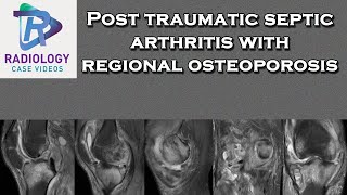 Post traumatic septic arthritis with regional osteoporosis [upl. by Fernandez996]