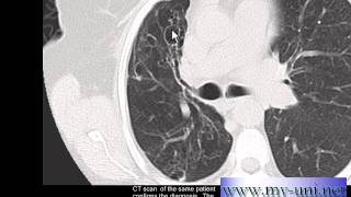 Chest xray Bronchiectasis on CT and Chest xray [upl. by Sprague]