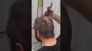 Curly Balding Hair Buzz Cut Transformation [upl. by Neerbas]