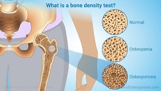 Test Panels for Bone Diseases  Osteoporosis and Fractures [upl. by Ashley395]