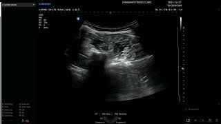 Lumbar erector spinae twitching response ultrasound guide epidural block L45 loss of resistance [upl. by Edahsalof]