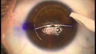 Removal of epithelial downgrowth after LASIK [upl. by Anadroj295]