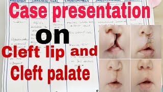 Case presentation on Cleft lip and Cleft palate  cleftlip cleftpalate NCP on Cleft Lip [upl. by Norman]