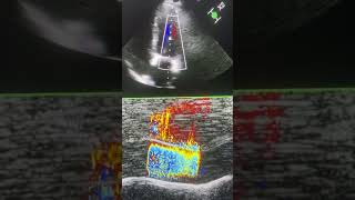 Mitral valve stenosis more important than at the level of the commissures [upl. by Byrle355]