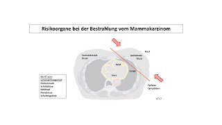 Risikoorgane bei der Bestrahlung vom Mammakarzinom  Strahlentherapie Prof Hilke Vorwerk [upl. by Tuneberg882]